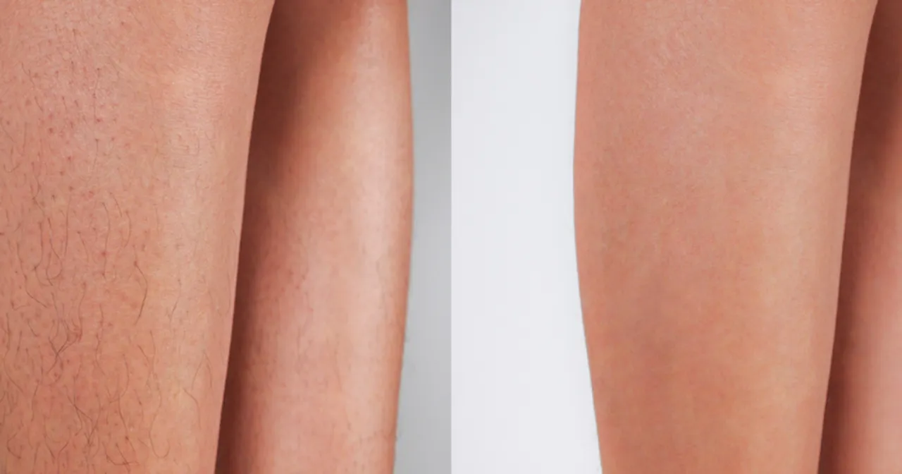 Przed i po depilacji laserowej. Widoczne efekty: gładka skóra bez owłosienia.