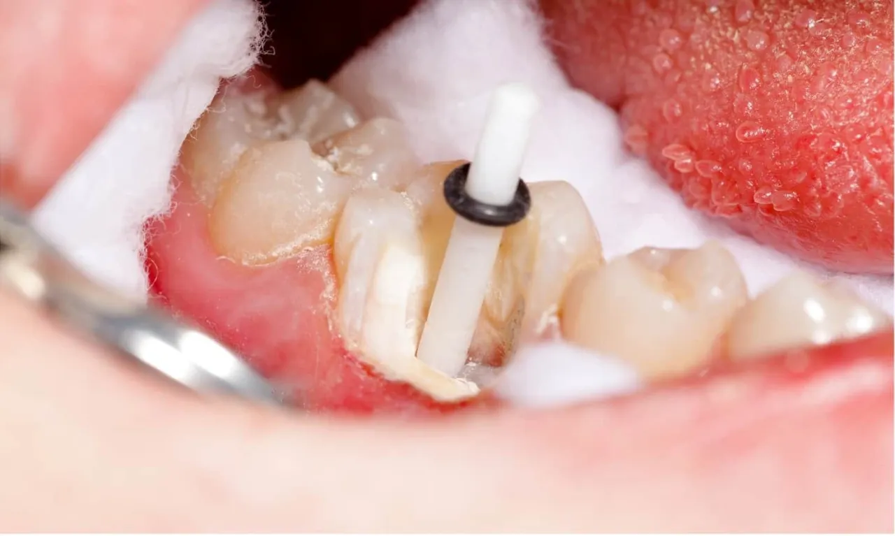 rodzaje odbudowy zęba po leczeniu kanałowym