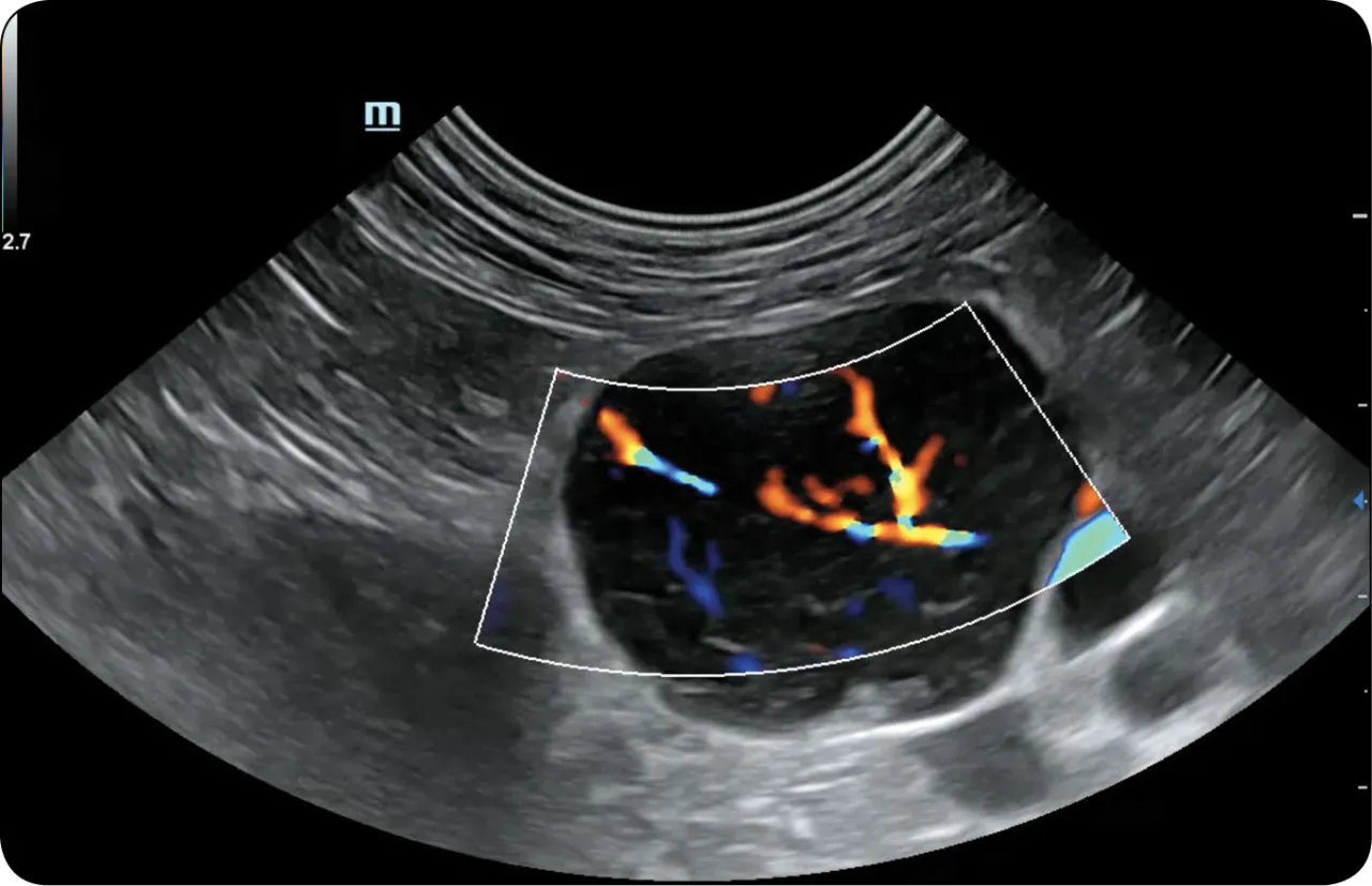 USG węzł&oacute;w chłonnych obraz