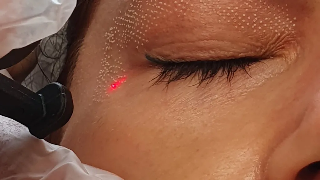 Makijaż mineralny po laserze frakcyjnym