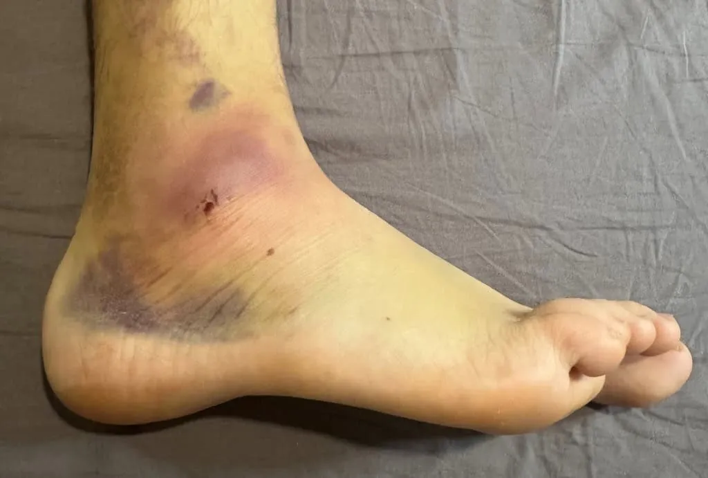 skręcona kostka objawy obrzęk krwiak