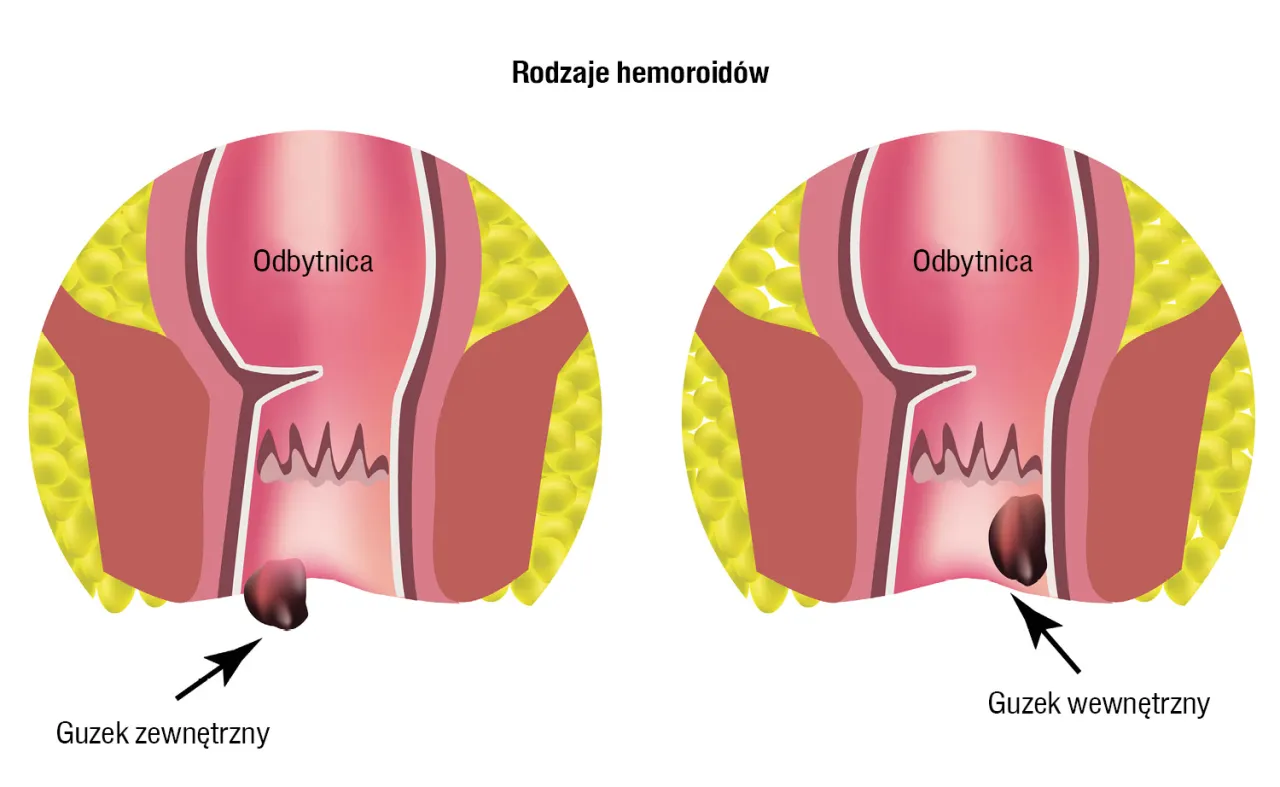 rodzaje hemoroid&oacute;w wewnętrzne zewnętrzne diagram