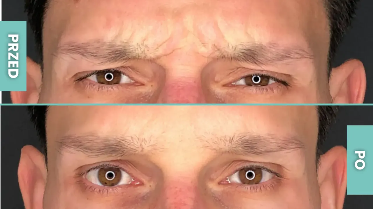 por&oacute;wnanie botoks kwas hialuronowy czoło