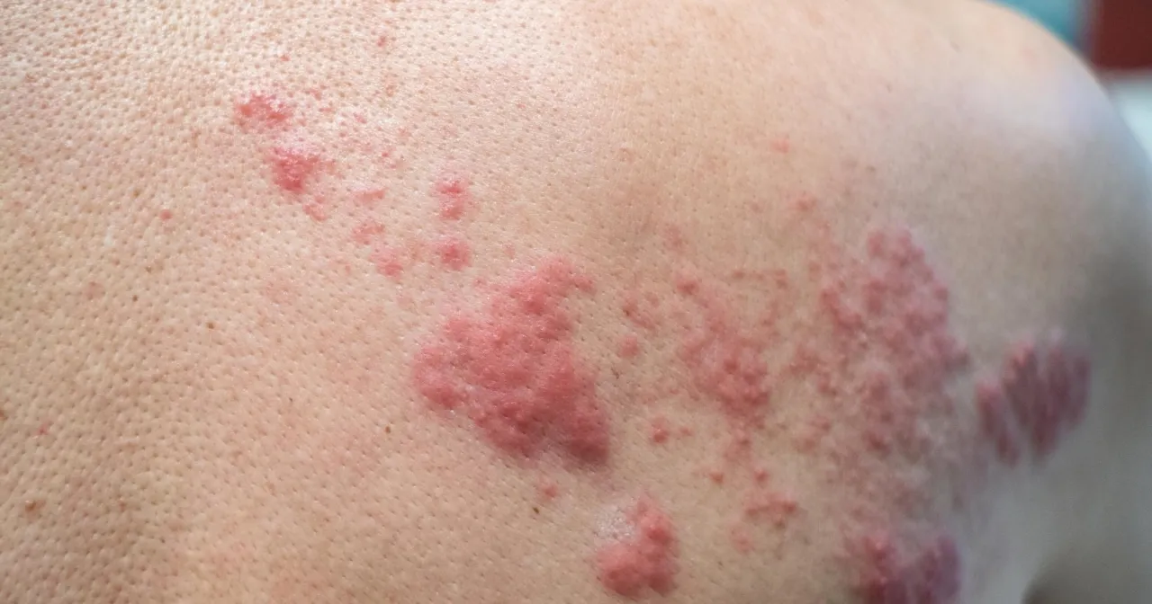 Sk&oacute;ra z wysypką i zaczerwienieniem, objawy p&oacute;łpaśca. Dowiedz się, jak złagodzić b&oacute;l przy p&oacute;łpaścu.