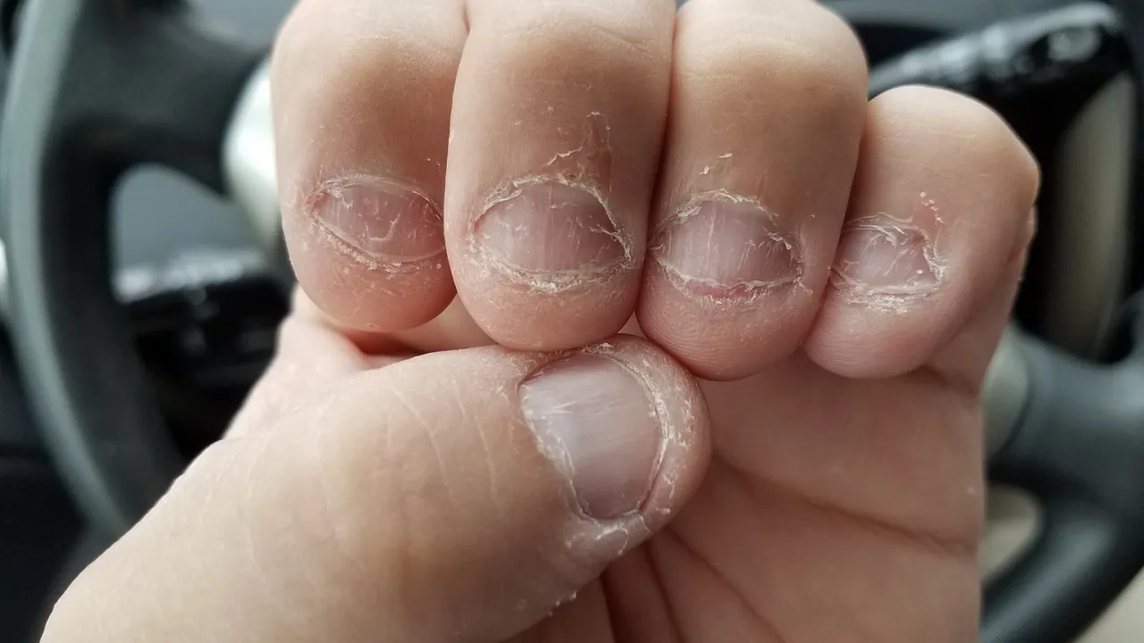 osoba zestresowana obgryzająca paznokcie