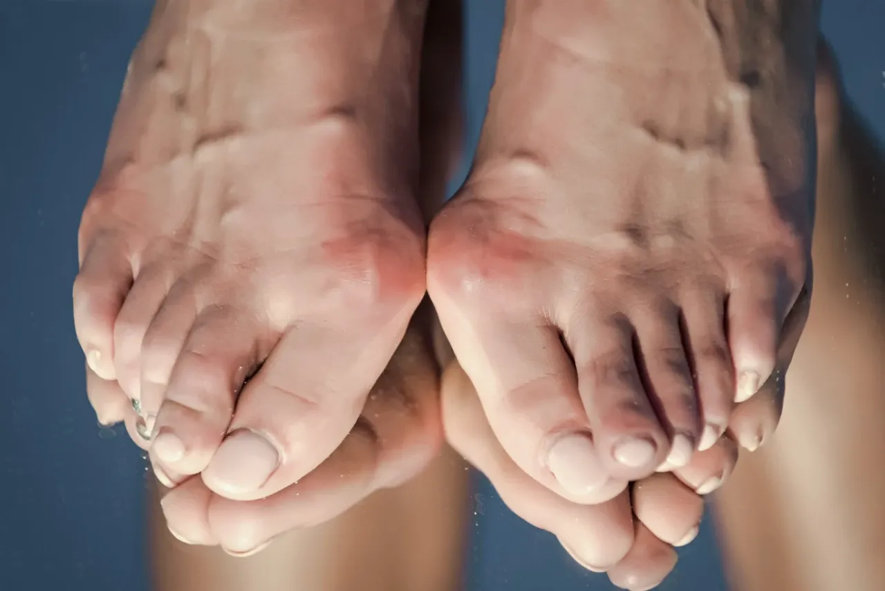 domowe sposoby na ból haluksa okłady zimne kąpiele solankowe