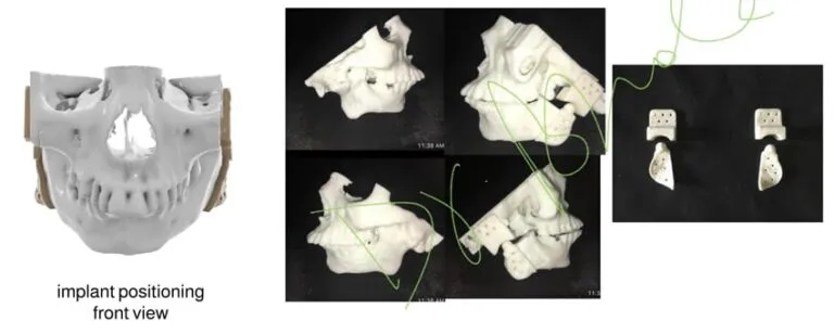 druk 3D implanty medyczne