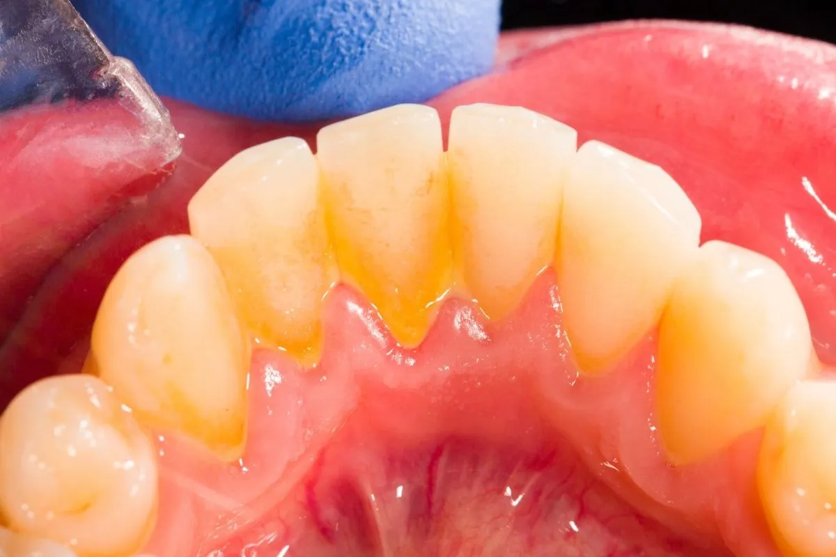 płytka nazębna i kamień nazębny na zębach