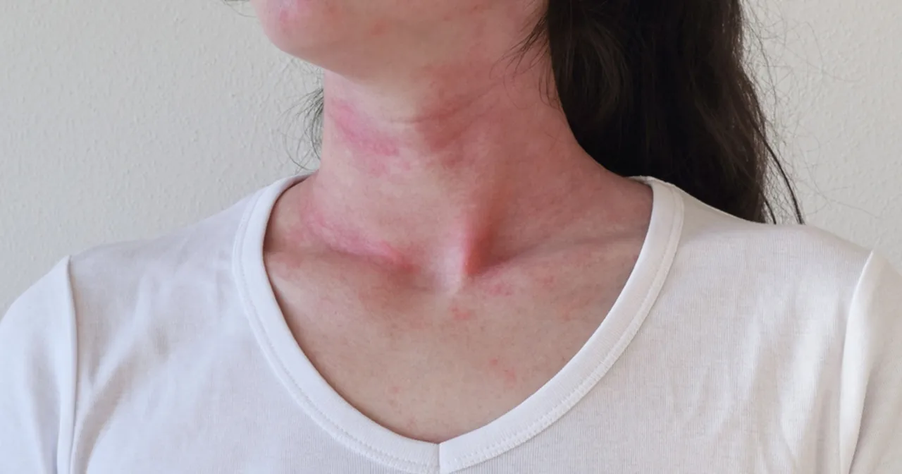 Wstrząs anafilaktyczny objawy