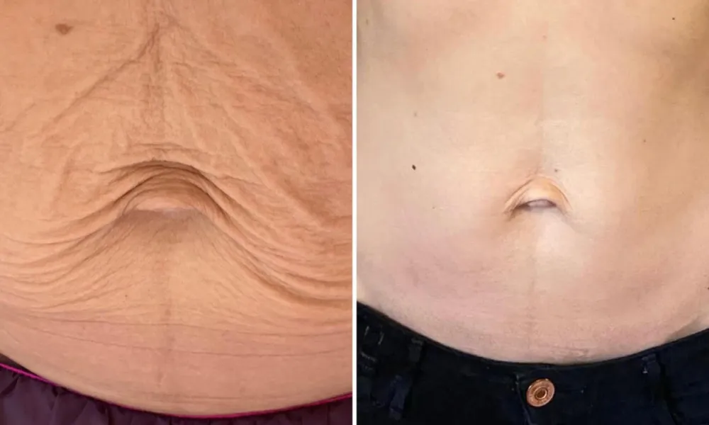 masaż brzucha efekty przed i po, ujędrnianie skóry masażem