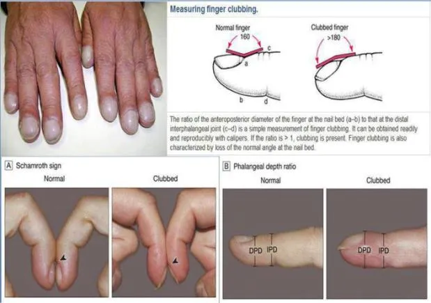 Nietypowe kształty paznokci choroby