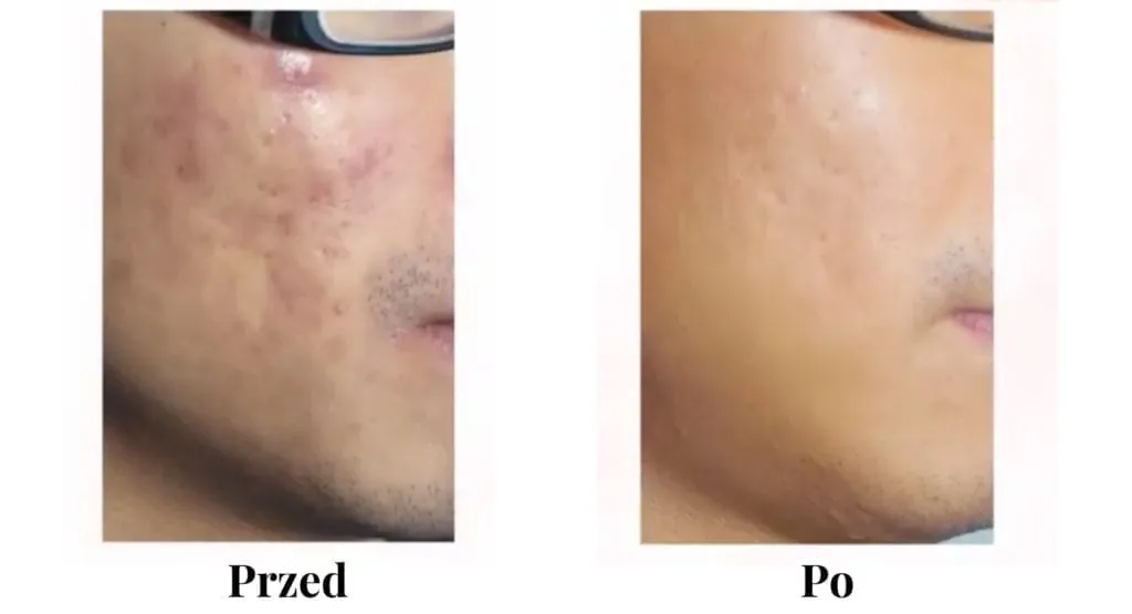 profesjonalne zabiegi na blizny potrądzikowe przed i po