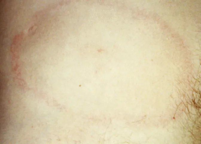 rumień wędrujący borelioza zdjęcia