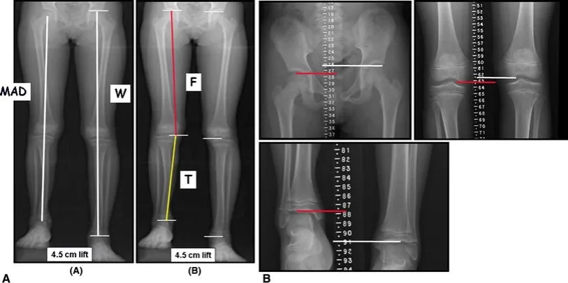 r&oacute;żnica długości n&oacute;g anatomiczna funkcjonalna