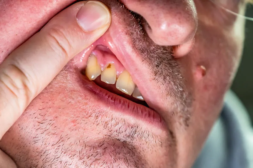 rana na dziąśle przyczyny