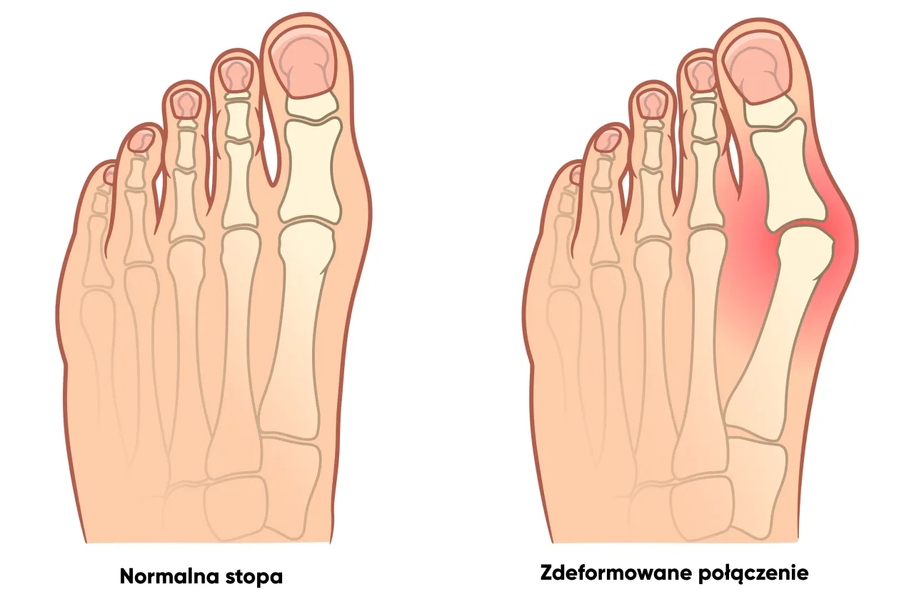 Haluksy stopa porównanie