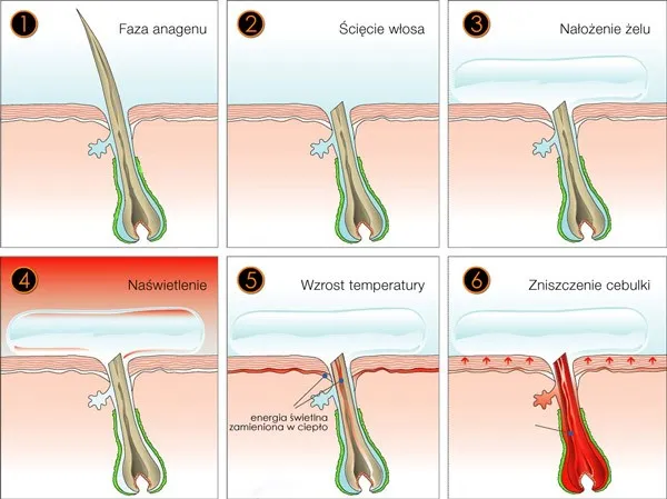 Jak działa laser diodowy do depilacji schemat