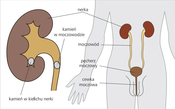 kamica nerkowa objawy leczenie grafika