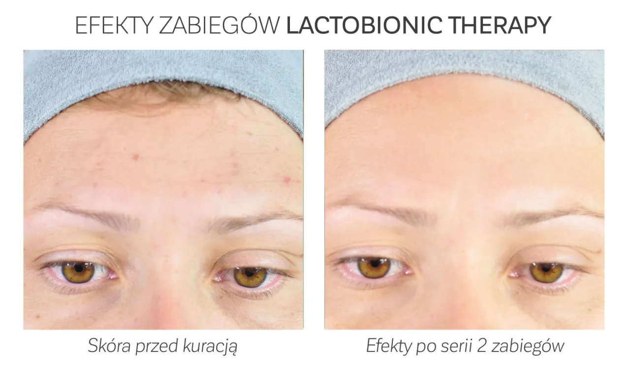 kwas laktobionowy cząsteczka i skóra