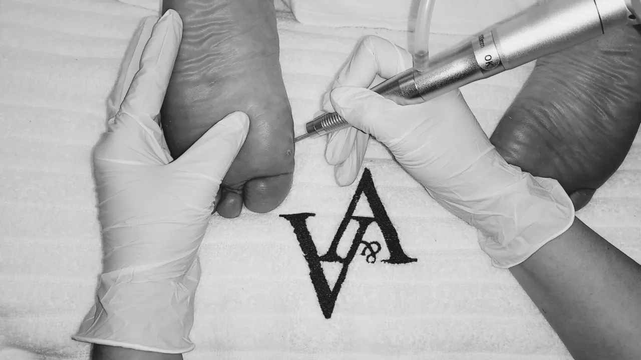 usuwanie odcisk&oacute;w laser CO2