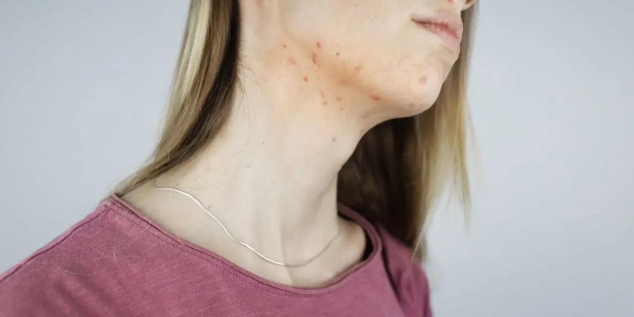 Kobieta z trądzikiem hormonalnym na szyi