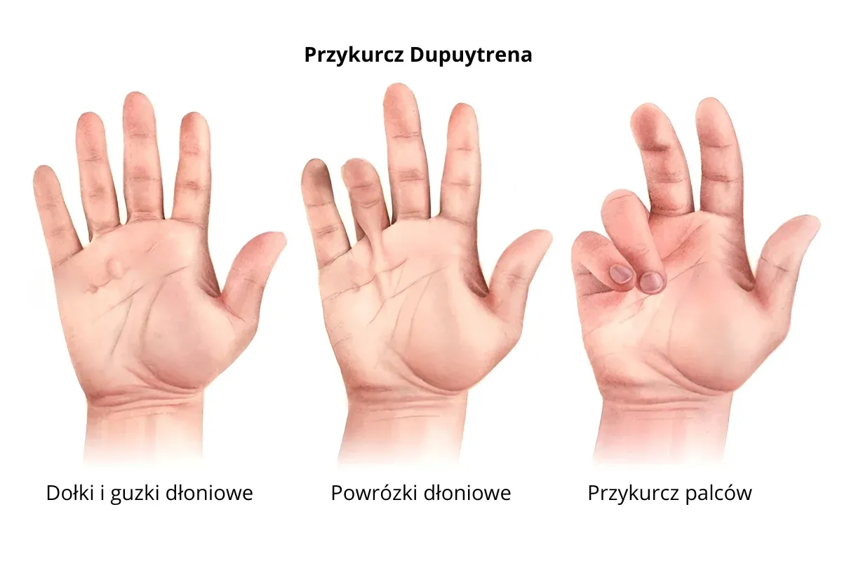 Przykurcz Dupuytrena objawy dłoń