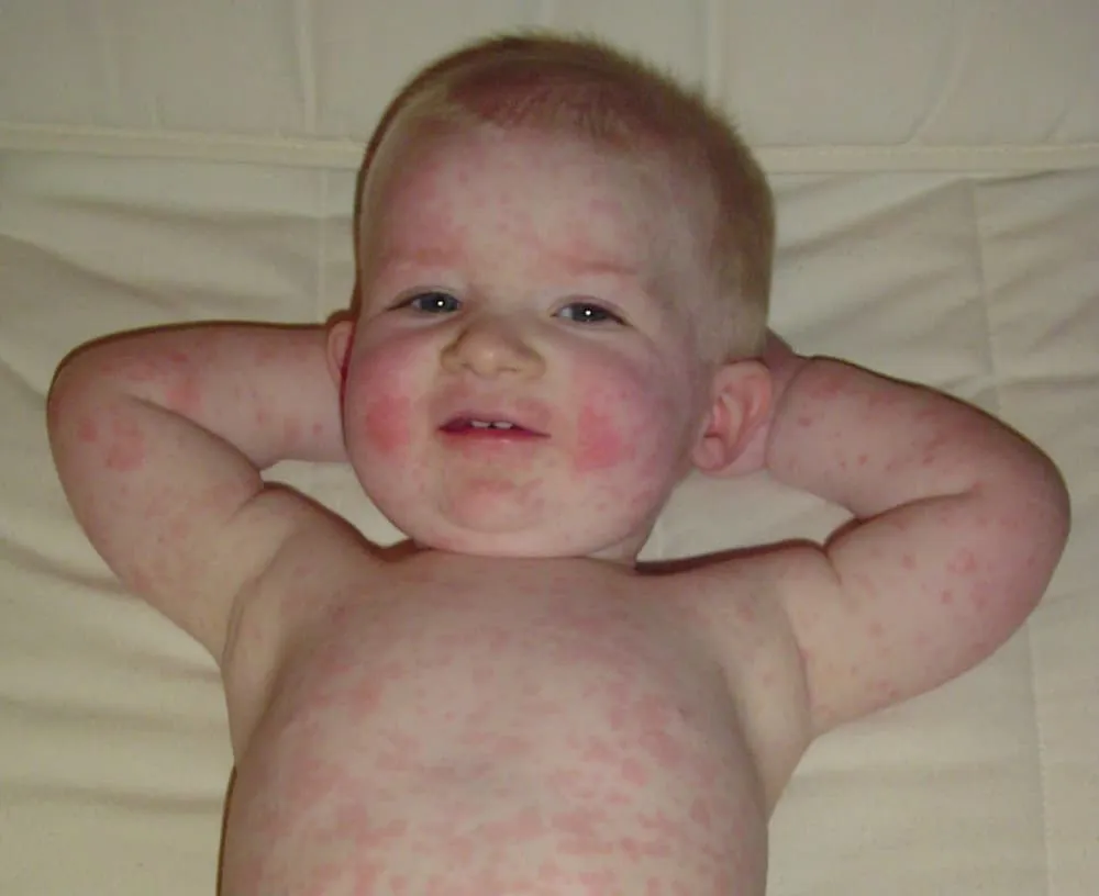 rumień u niemowląt rodzaje zdjęcia