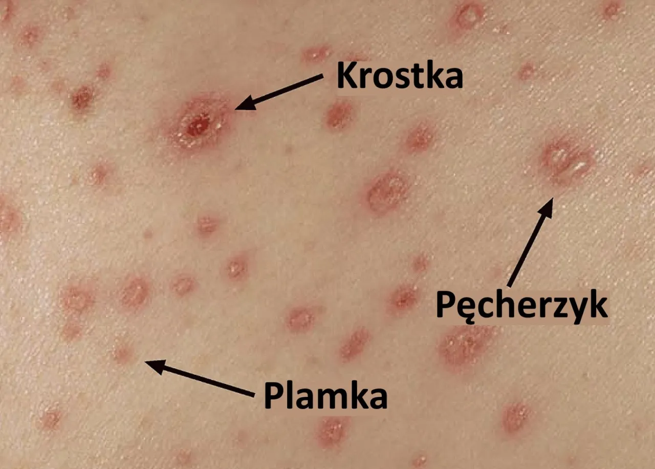 Ospa wietrzna wysypka etapy rozwoju u dziecka
