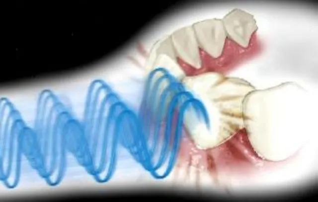 Szczoteczka ultradźwiękowa zasada działania