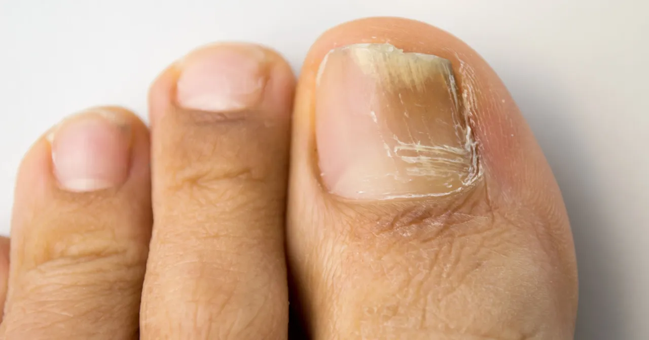 Rodzaje grzybicy paznokci objawy porównanie