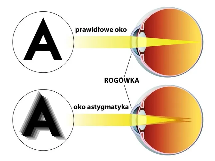 schemat oka z astygmatyzmem i prawidłowego