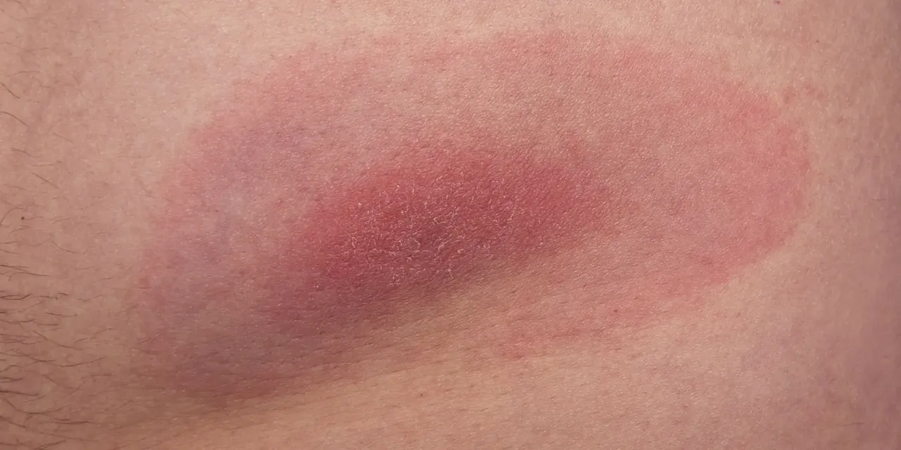 Odczyn alergiczny po ugryzieniu kleszcza vs rumień