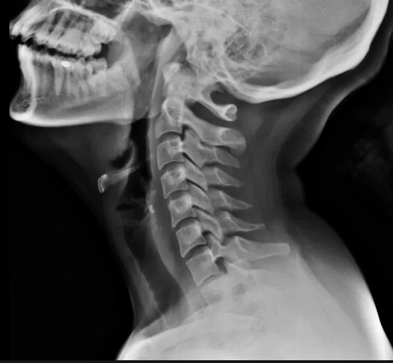 diagnostyka skręcenia kręgosłupa szyjnego RTG MRI