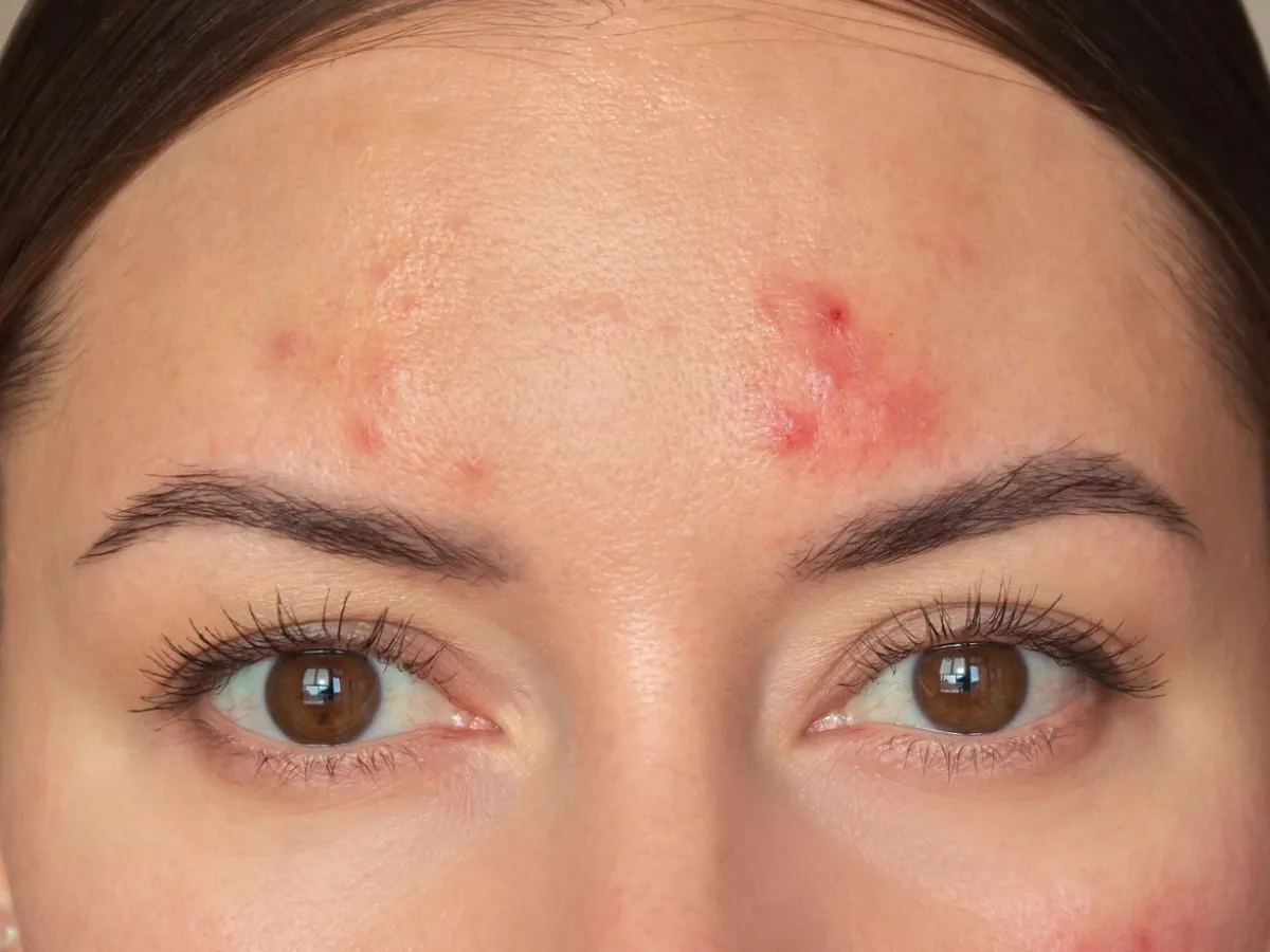 Składniki aktywne w kosmetykach na trądzik