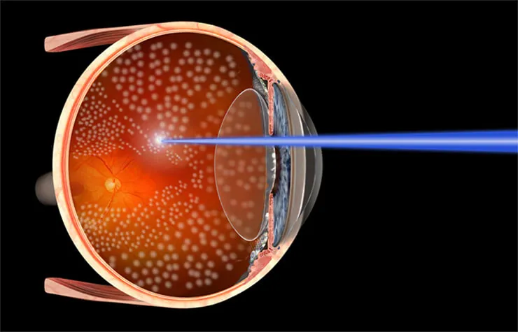 Laseroterapia siatkówki oka schemat