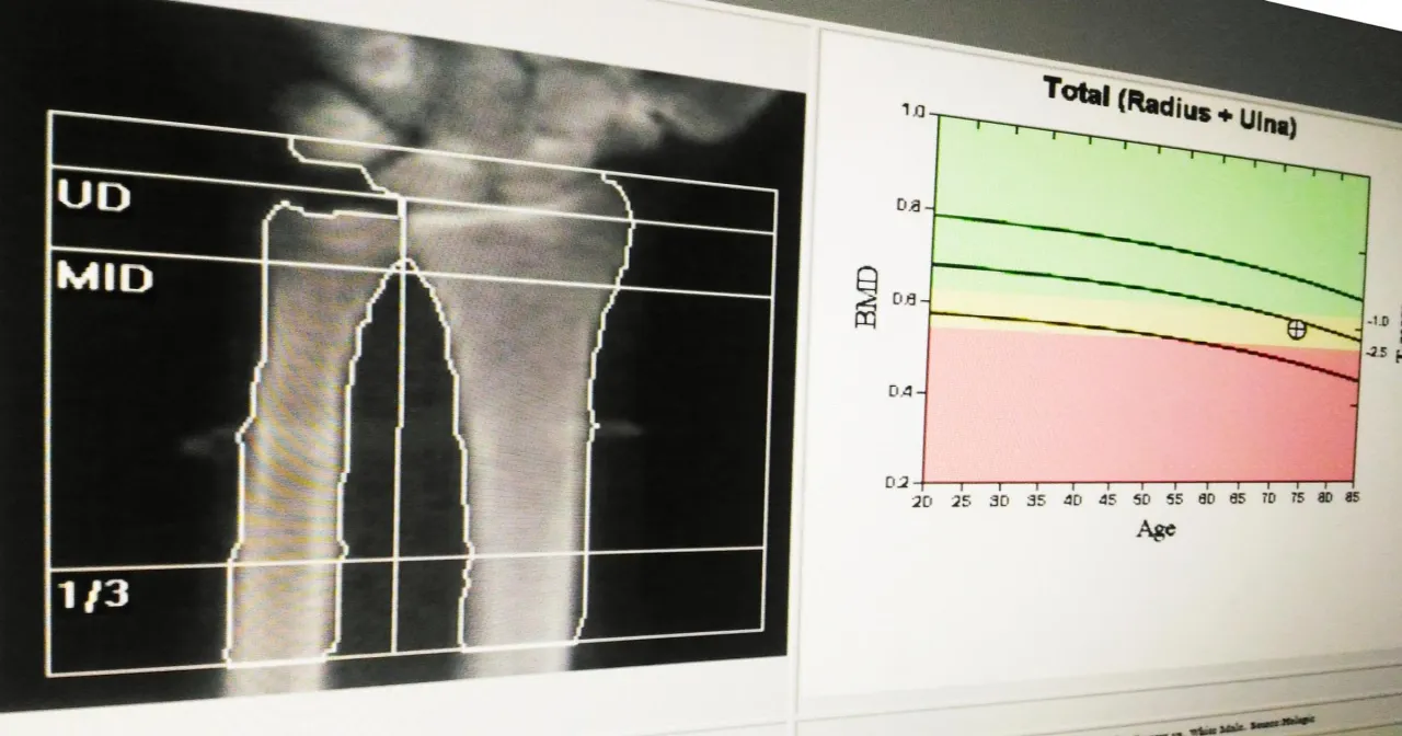 Wynik badania na osteoporozę: obraz RTG przedramienia i wykres BMD w funkcji wieku.