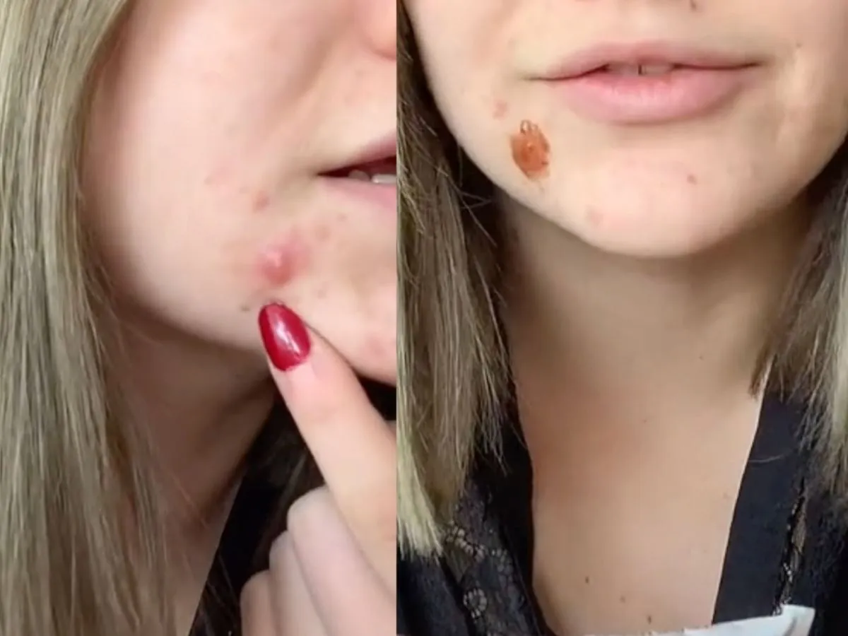 Lód na pryszcze przed i po