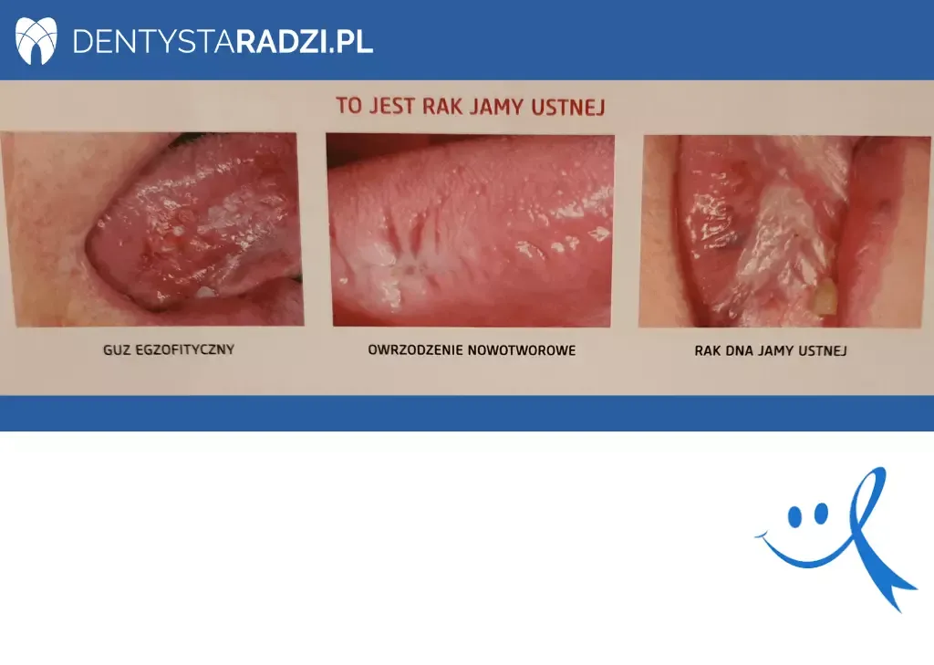 rak dna jamy ustnej objawy wczesne zdjęcia