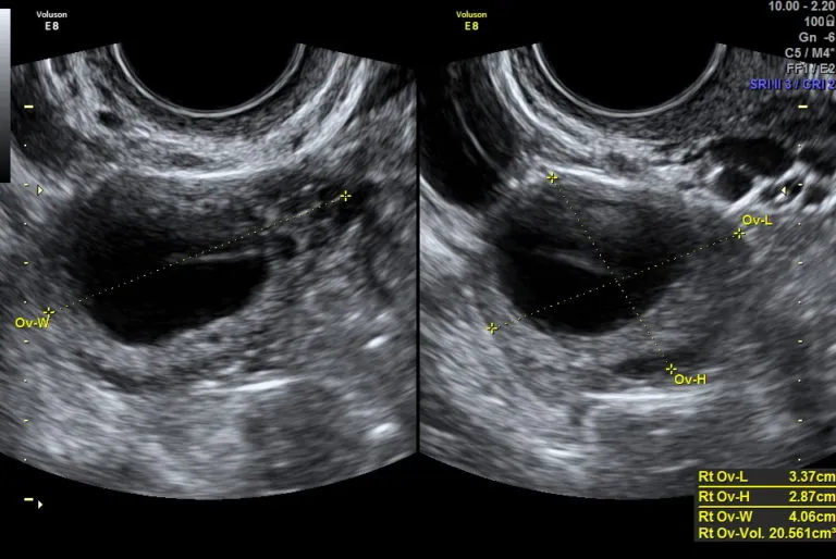 Testy owulacyjne i monitoring USG