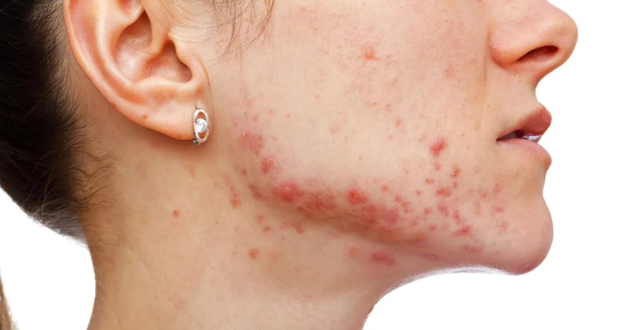 skuteczne sposoby na pryszcze