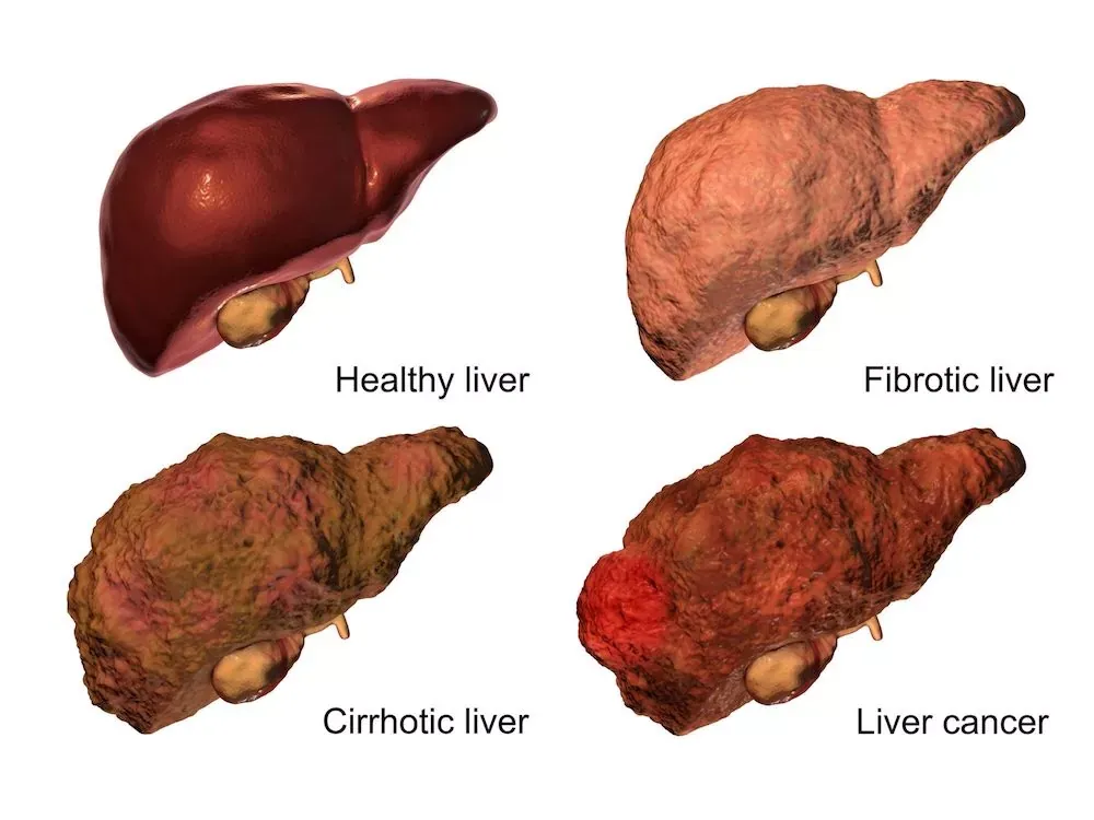 Uszkodzona wątroba, stłuszczenie wątroby, marskość wątroby