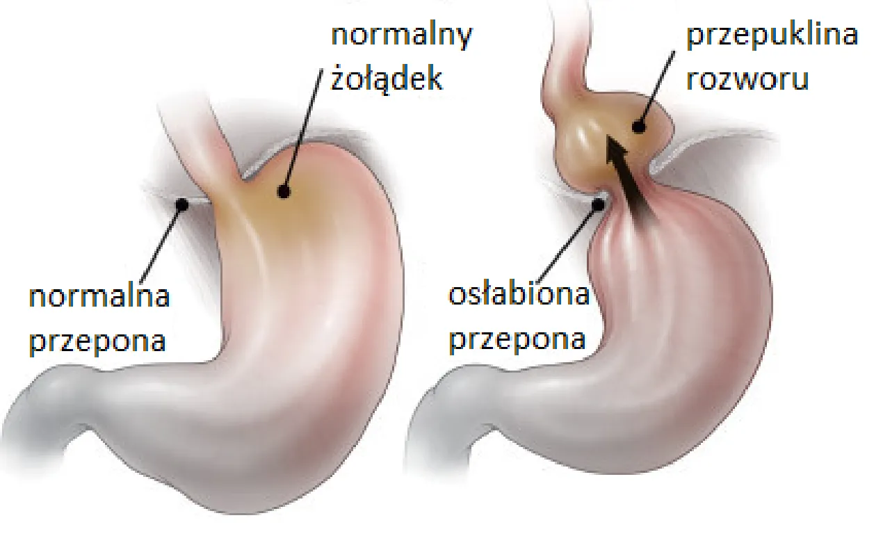 Zdjęcie Skuteczne leki na przepuklinę rozworu przełykowego - co pomaga?