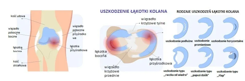 Zdjęcie Pozioma szczelina łąkotki przyśrodkowej: Jak leczyć? Porady