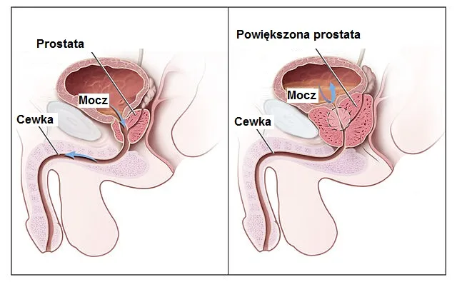 Zdjęcie Dopuszczalna wielkość prostaty: co powinieneś wiedzieć o normach zdrowotnych
