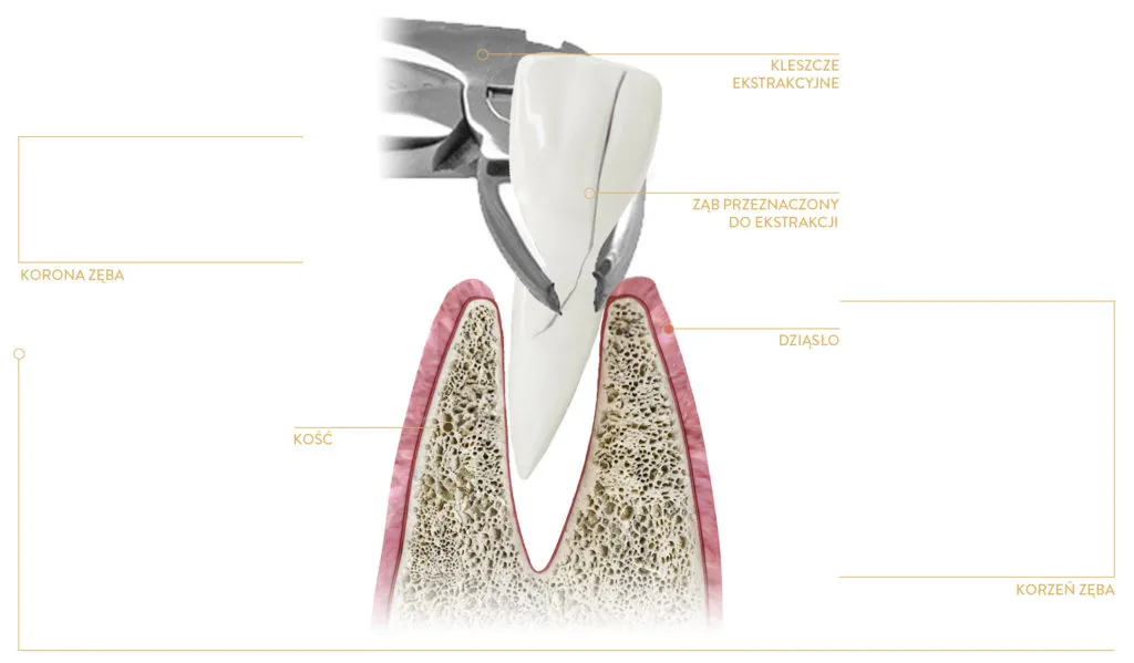 Zdjęcie Ile trwa wyrywanie zęba 5? Czas zabiegu, który może zaskoczyć