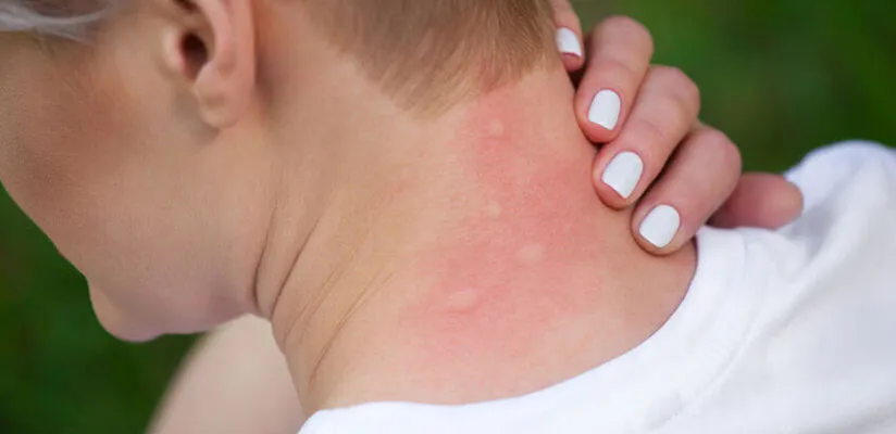 Zdjęcie Alergia objawy skórne: Jak rozpoznać i unikać nieprzyjemnych skutków