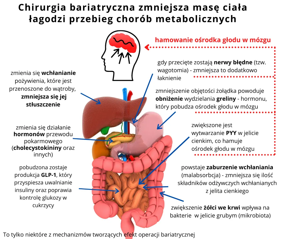 Zdjęcie Operacja bariatryczna jakie bmi - sprawdź, czy kwalifikujesz się