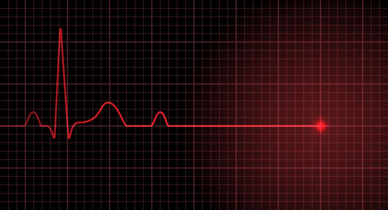 Migotanie komór serca schemat