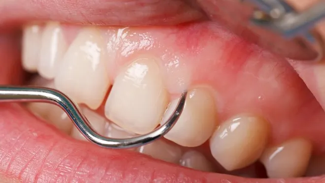 kiedy iść do dentysty z bólem dziąsła