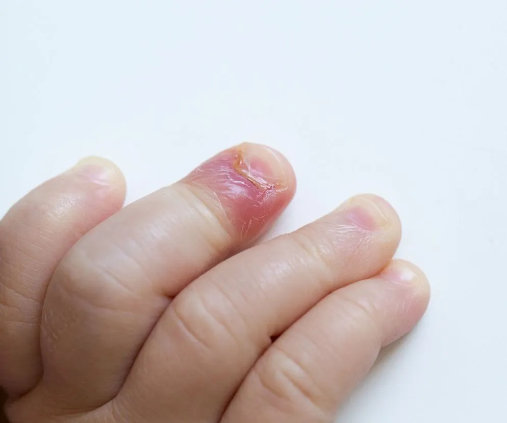 zastrzał u dziecka objawy początkowe